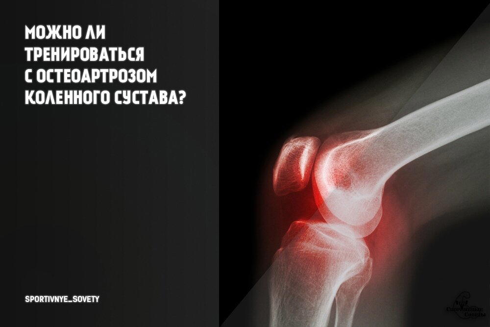 Можно ли тренироваться с остеоартрозом коленного сустава?