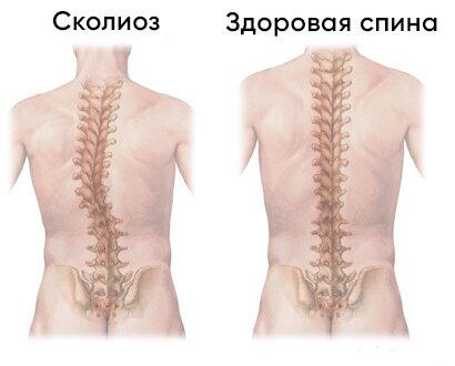 О сколиозе
