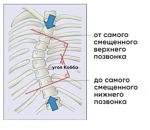 О сколиозе