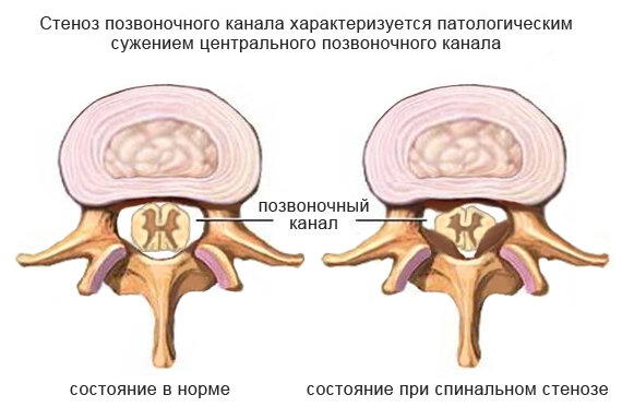 Остеохондроз. Нужно ли качать спину?