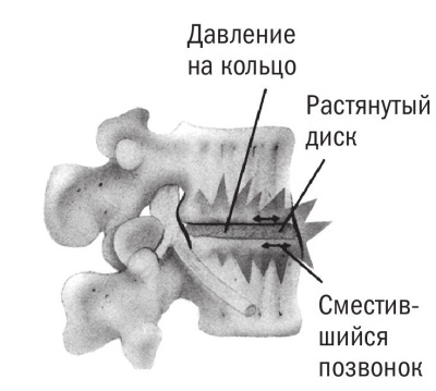 Остеохондроз. Нужно ли качать спину?