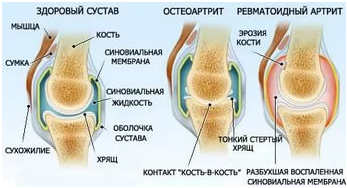 Боль в колене