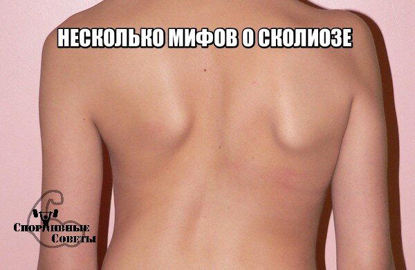 Несколько мифов о сколиозе