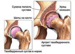 Болят суставы? Что делать?... хз