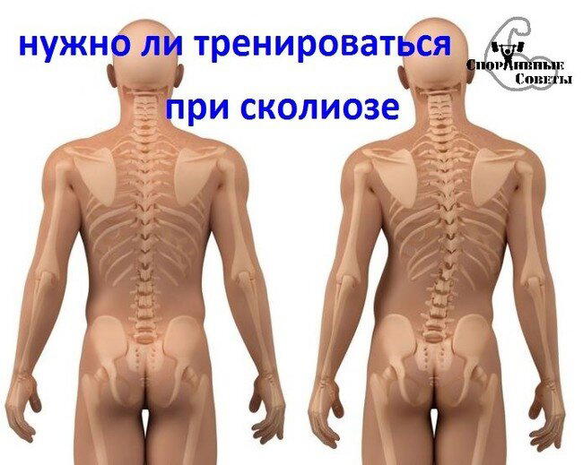 Нужно ли тренироваться при сколиозе