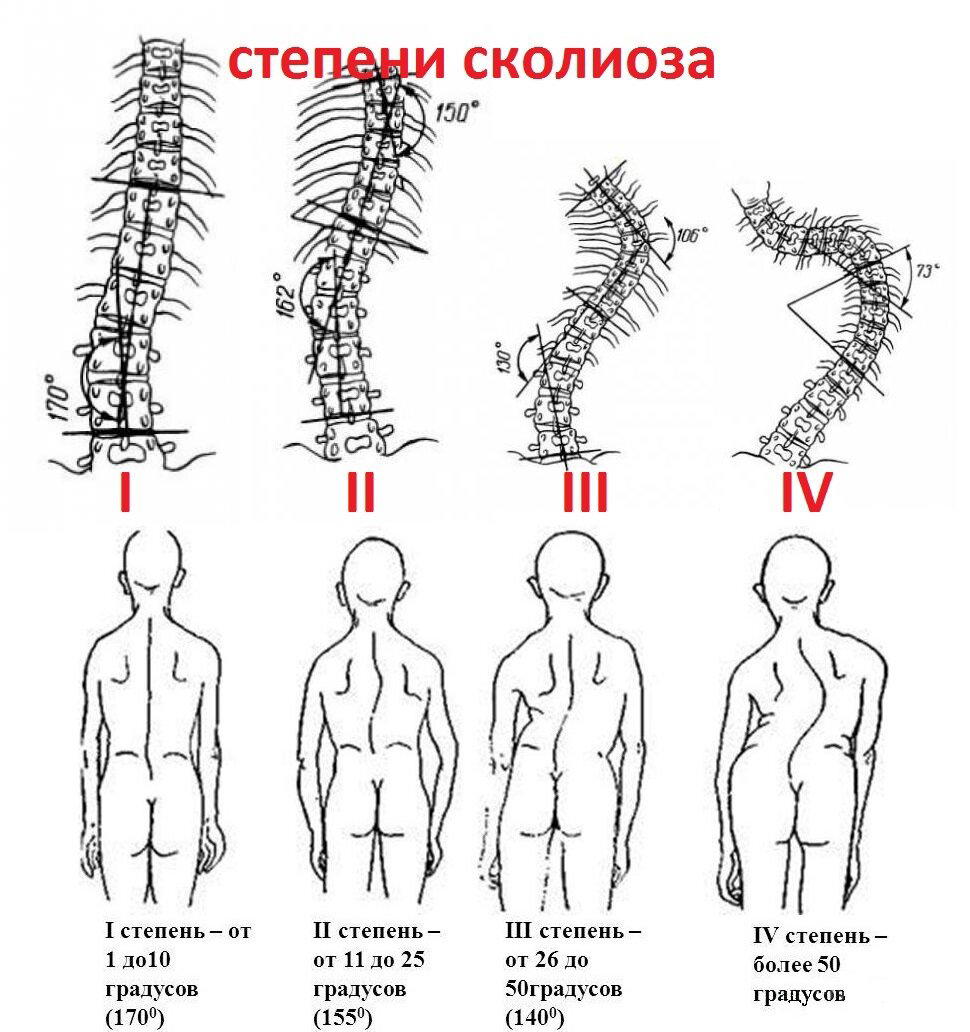 Нужно ли тренироваться при сколиозе