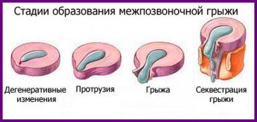 Коротко о протрузиях, грыжах и осевых нагрузках