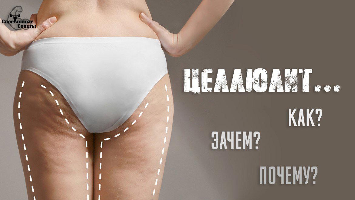 Целлюлит: как, зачем и почему?