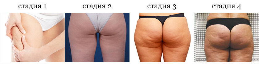 Целлюлит: как, зачем и почему?