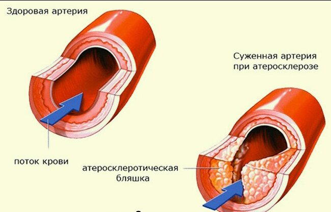 Сердечно-сосудистая система, атеросклероз, или как дожить до ста лет