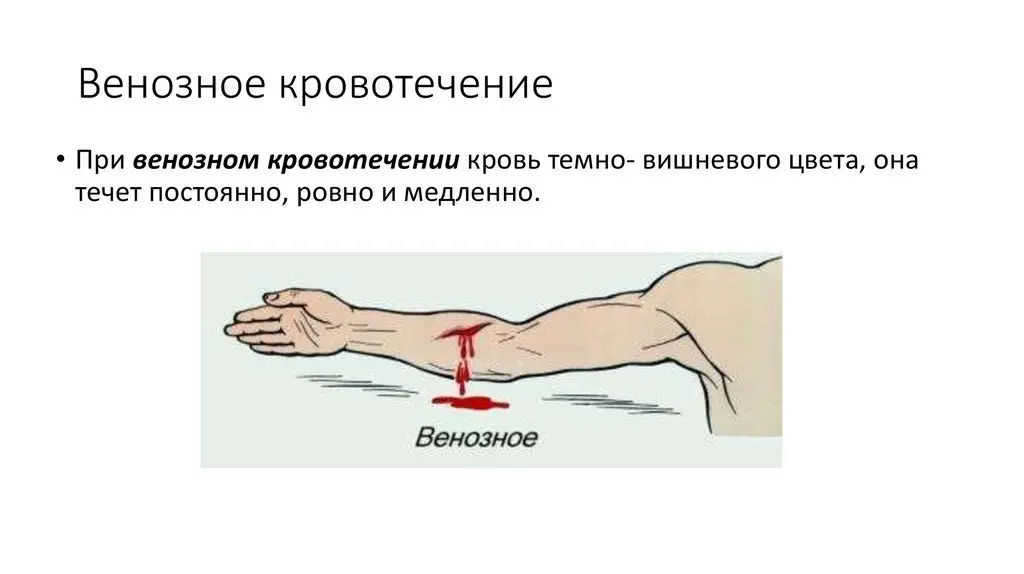 Урок №4 Венозное кровотечение, безопасность и способы остановки (часть первая)