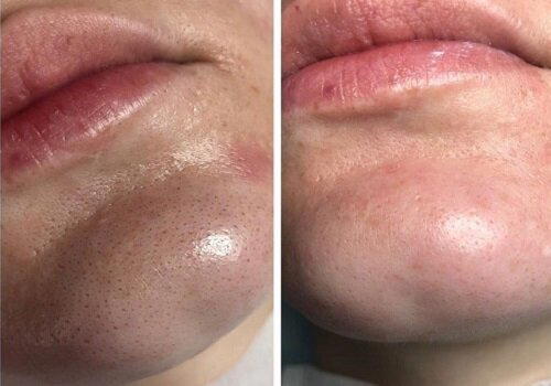 До и после процедуры ультразвуковой чистки лица