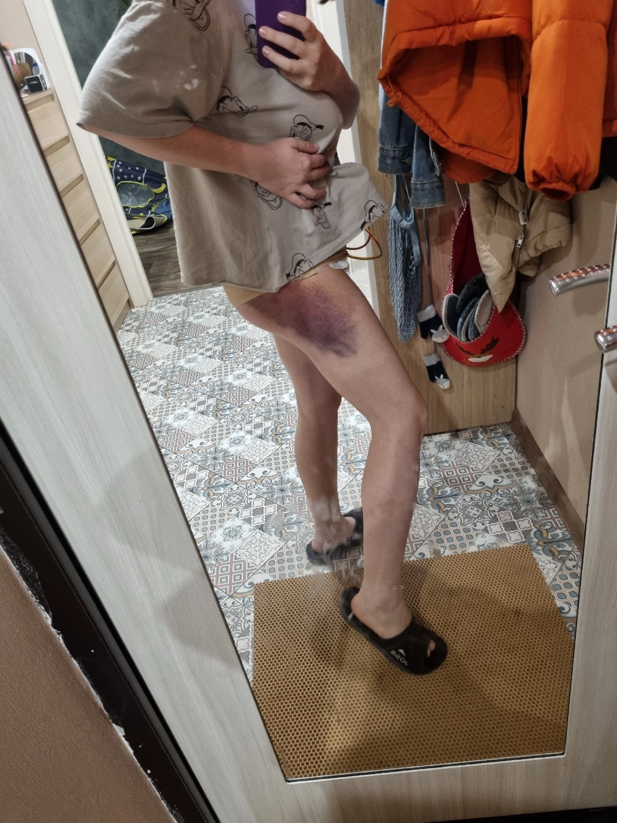 Абдоминопластика