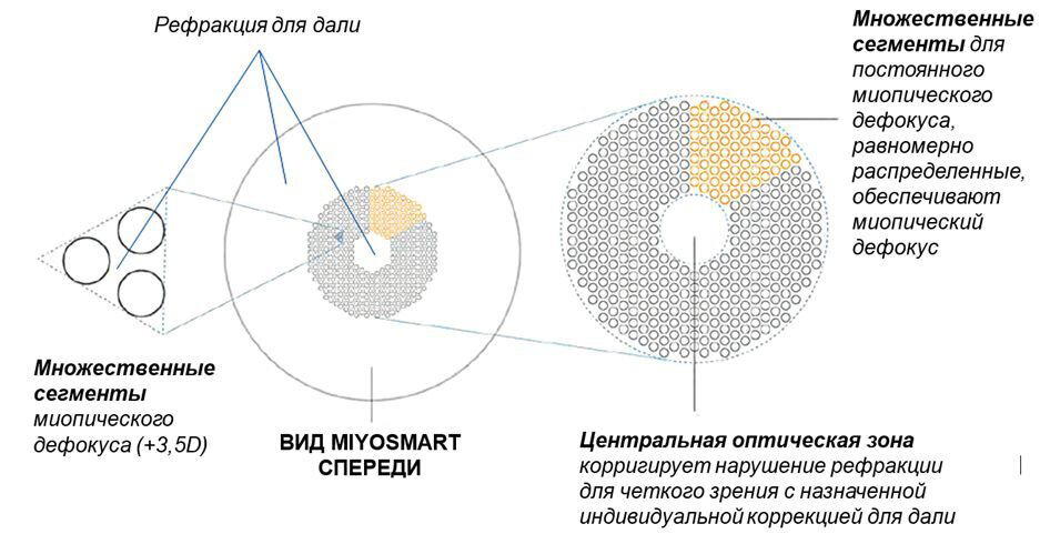 Грани хорошего зрения 3. Торможение миопии в детстве, существующие способы