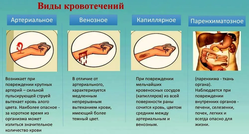 Урок №1 Виды кровотечений.