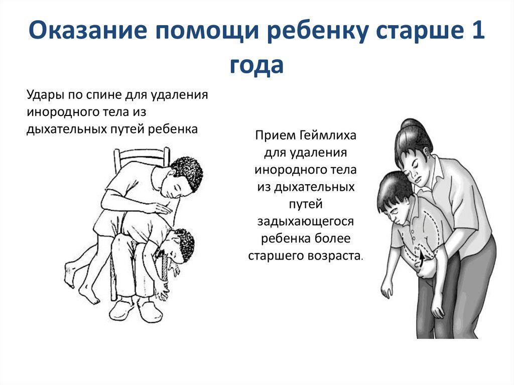 Прием Геймлиха детям
