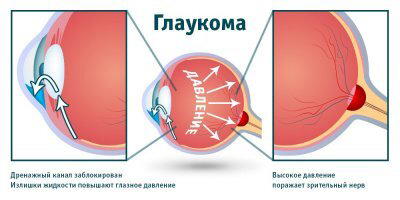Почему дергается глаз?