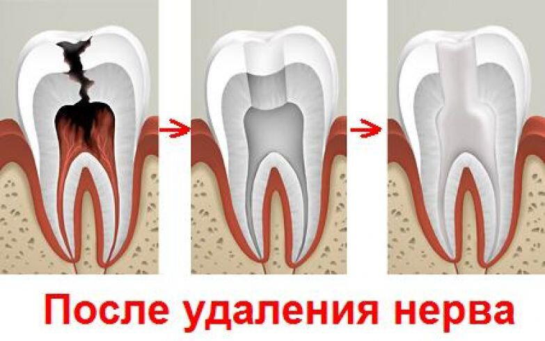 Зачем в зубах нервы?