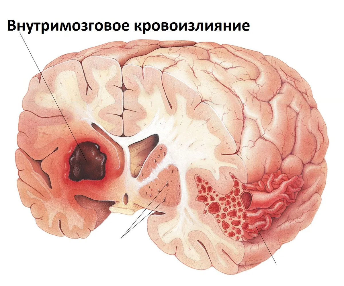 Урок №31 Внутримозговое кровоизлияние