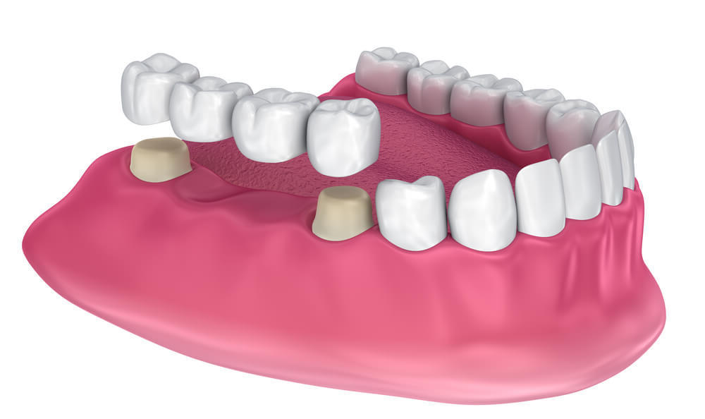Мост на коронки или культевые вкладки