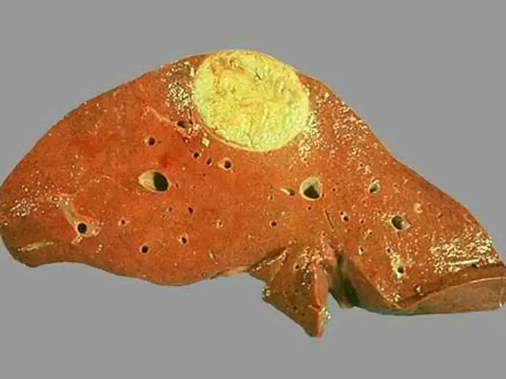 Черви, которые вас убьют (вернее их личинки)⁠