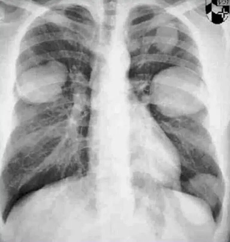 Черви, которые вас убьют (вернее их личинки)⁠