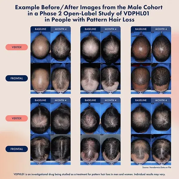 Тестируется несколько новых препаратов для лечения облысения