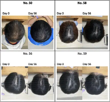 Тестируется несколько новых препаратов для лечения облысения
