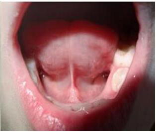 Причина моей шепелявости