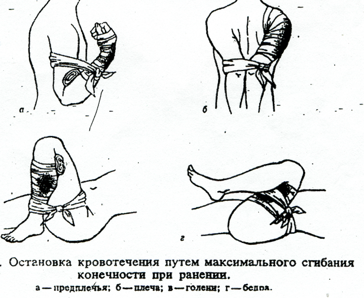 Урок №5 Венозное кровотечение, безопасность и способы остановки (часть вторая)